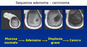 Sequenza adenoma - carcinoma