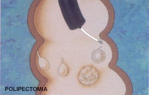 Polipectomia Endoscopica